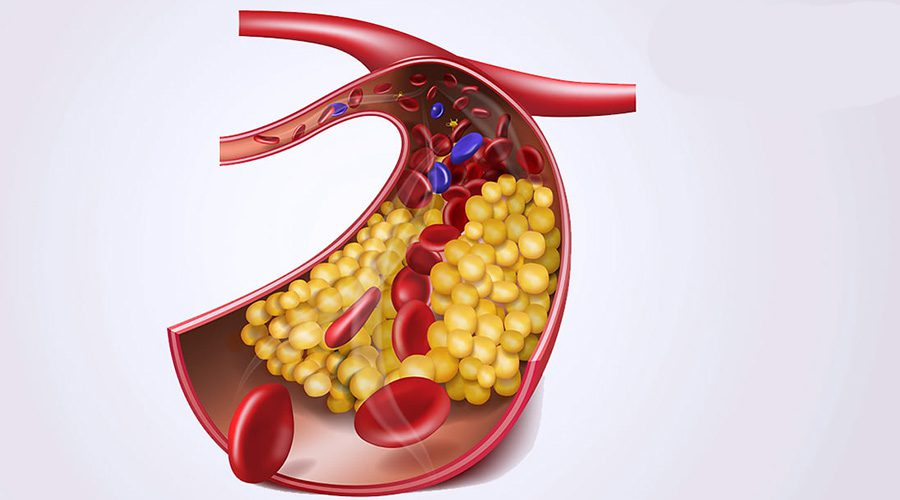 高血脂调理指南：血脂管理全方位