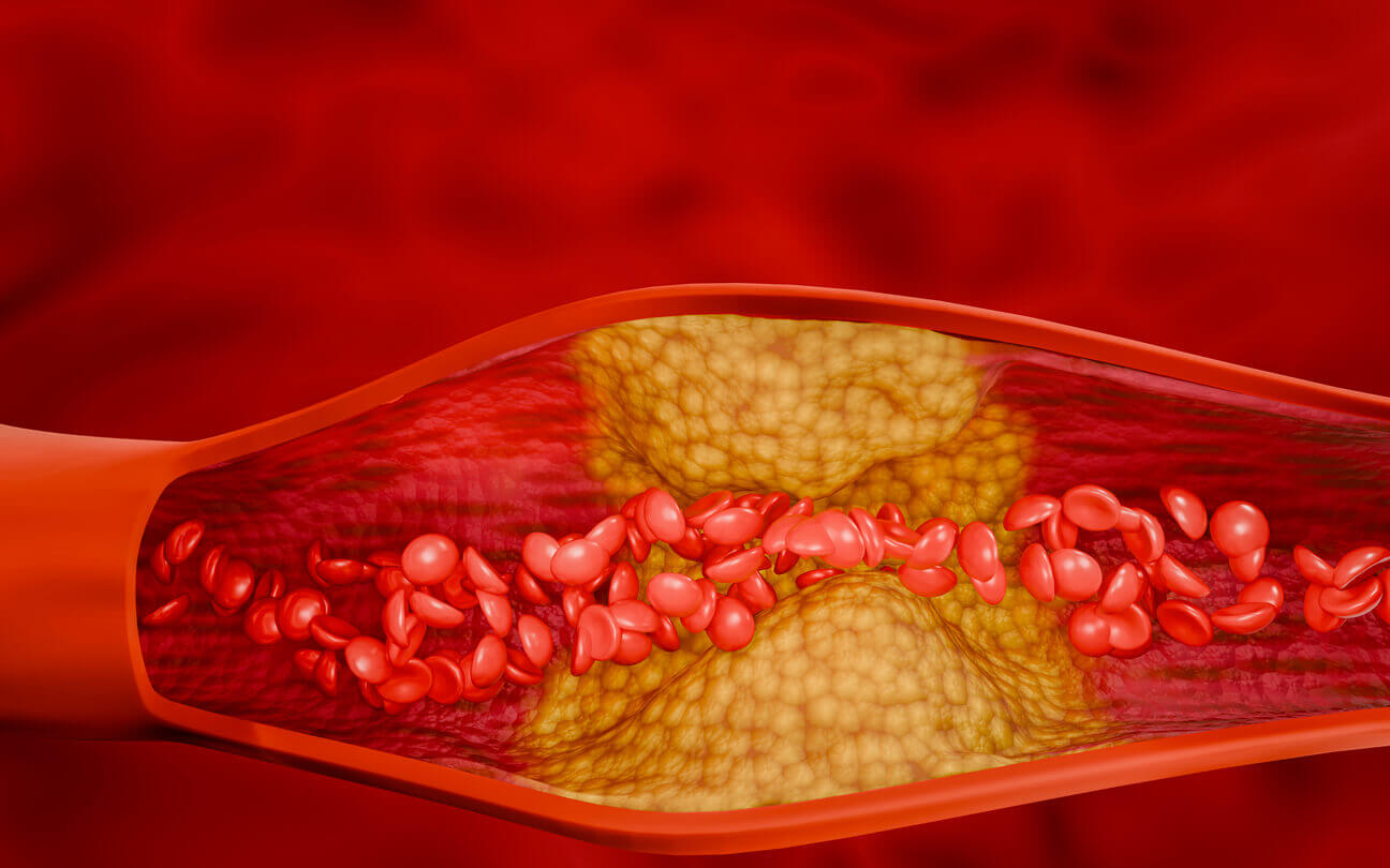 高脂血症的治疗性饮食干预