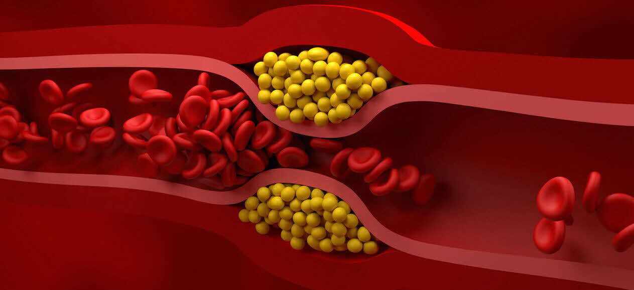 高脂血症的长期管理与预防复发