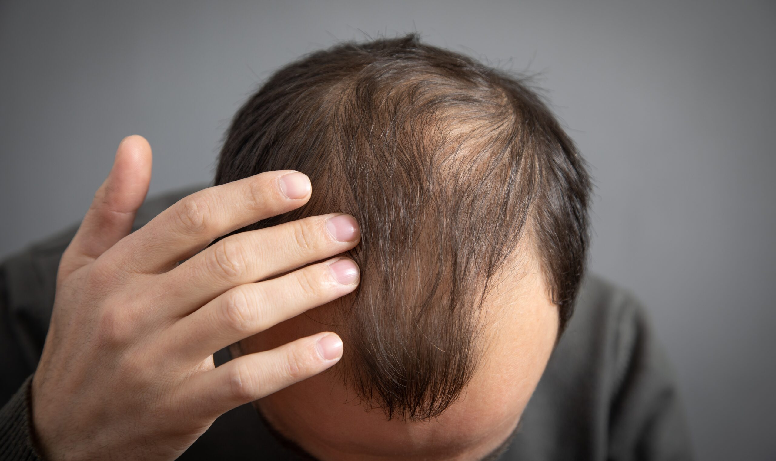 脱发的疾病概述与定义