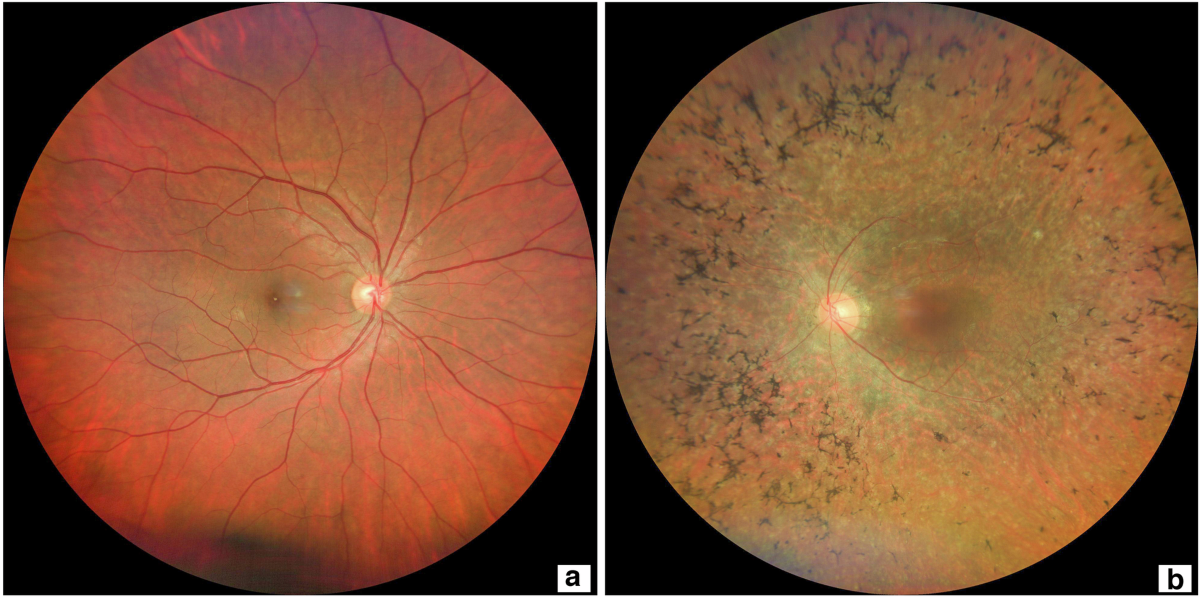 视网膜色素变性的疾病概述与定义