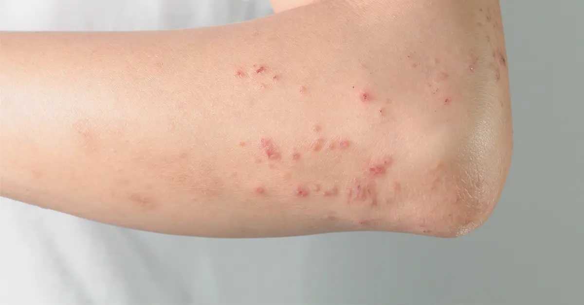 荨麻疹的病理生理机制