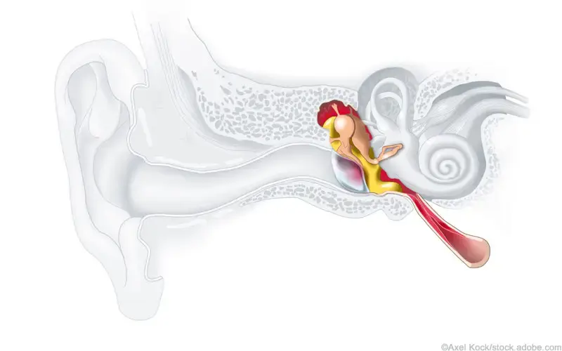 中耳炎的疾病概述与定义