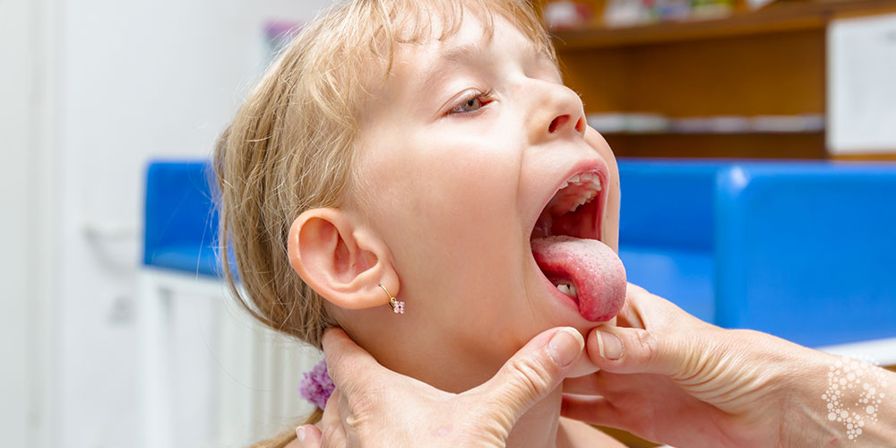 扁桃体炎的疾病概述与定义