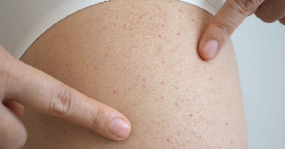 血小板减少症的常规医疗治疗方案