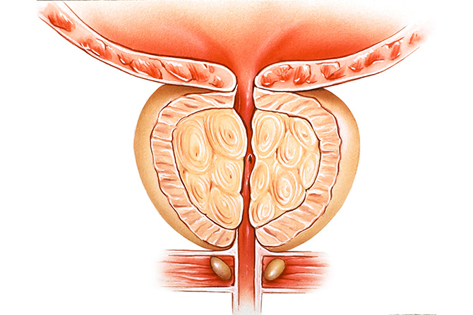 良性前列腺增生(BPH)的PSA报告解读与生活自救指南