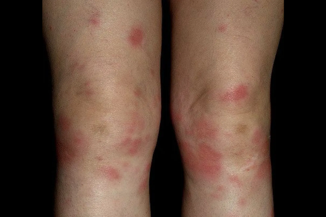 结节病的诊断方法与标准