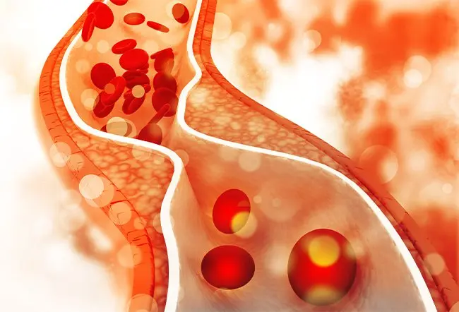 高血脂的“分级治疗”：什么时候需要药物介入？