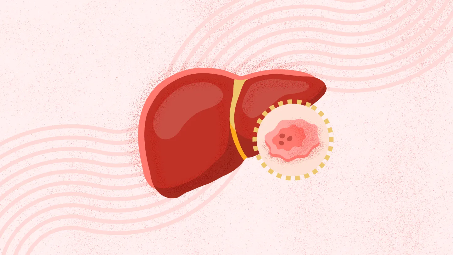 肝癌的生活方式调整策略