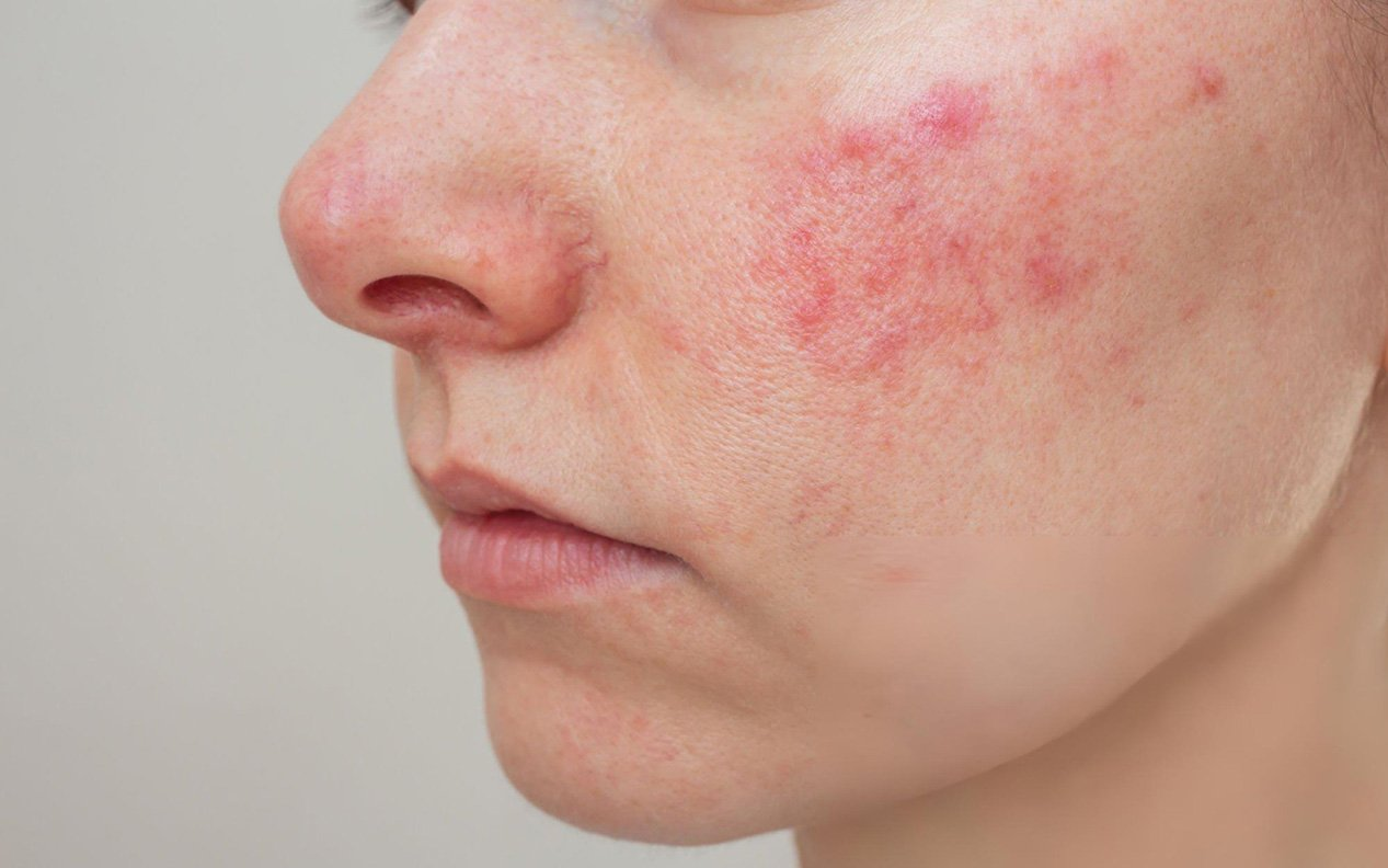 系统性红斑狼疮的特殊人群考虑